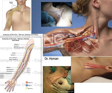 image Irritated nerves in neck can cause tingling and numbness in arm/hand