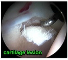 cartilage lesion