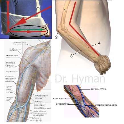 image Bent elbow leads to forearm/hand swelling