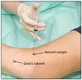 image Lateral knee injection