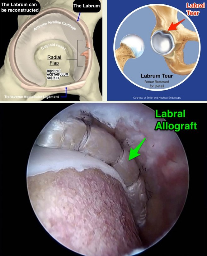 Labral reconstruction