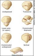 image Patella Fracture Patterns