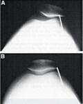 image before / after lateral release