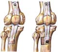 image tibial tubercle transfer