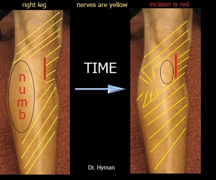 image Numbness shrinks away over time